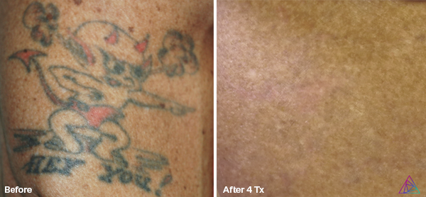 Before and after tattoo removal